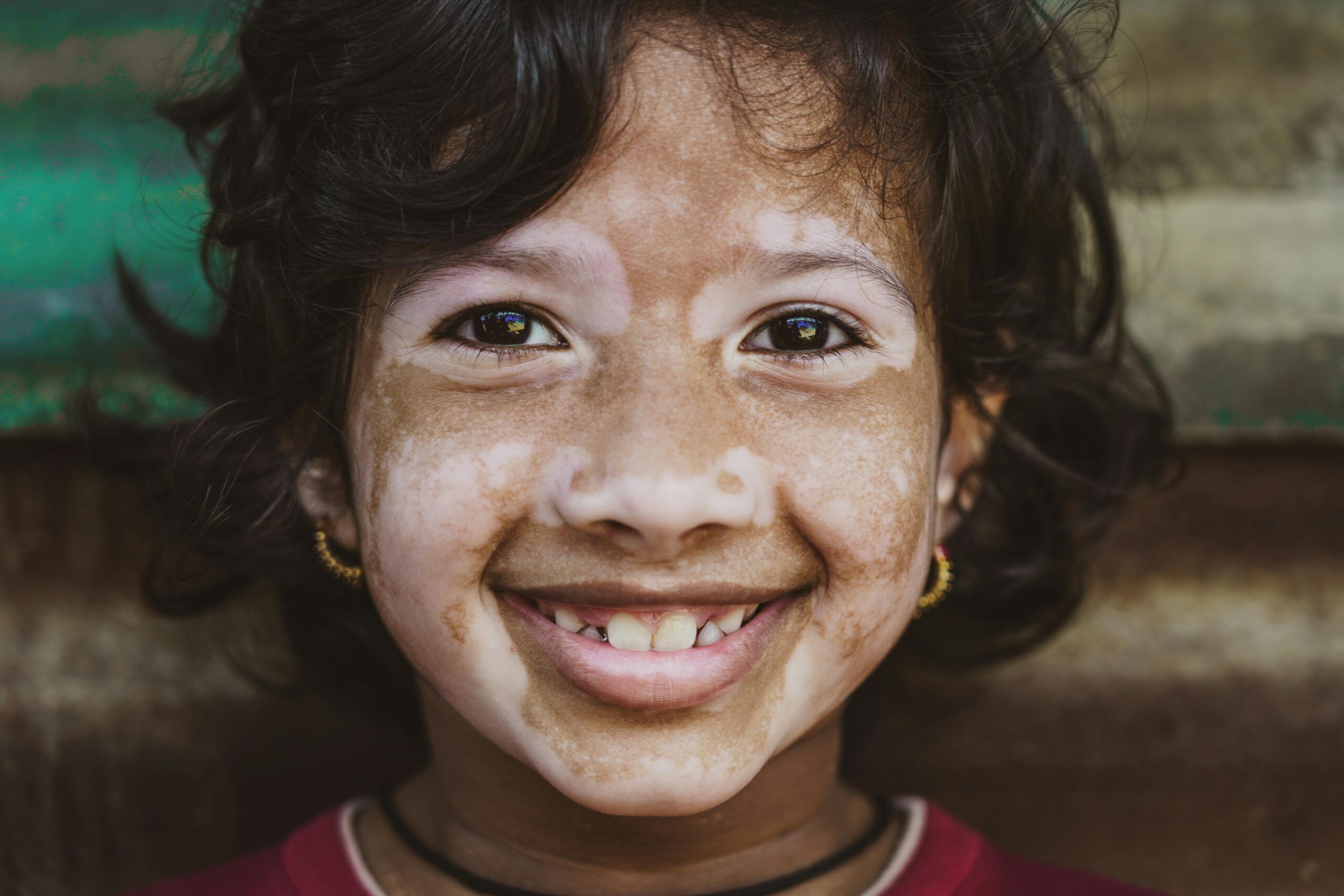 Close-up portrait of a smiling child with vitiligo in Hyderabad, India.